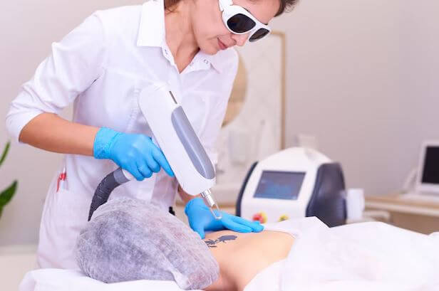 Tattoo Removal in Pitampura
