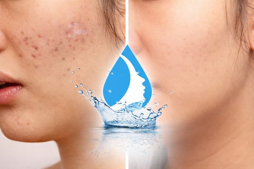 Acne Scar Removal Treatment